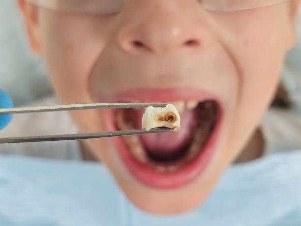 Best Emergency Wisdom Tooth Extraction in Beloit, OH